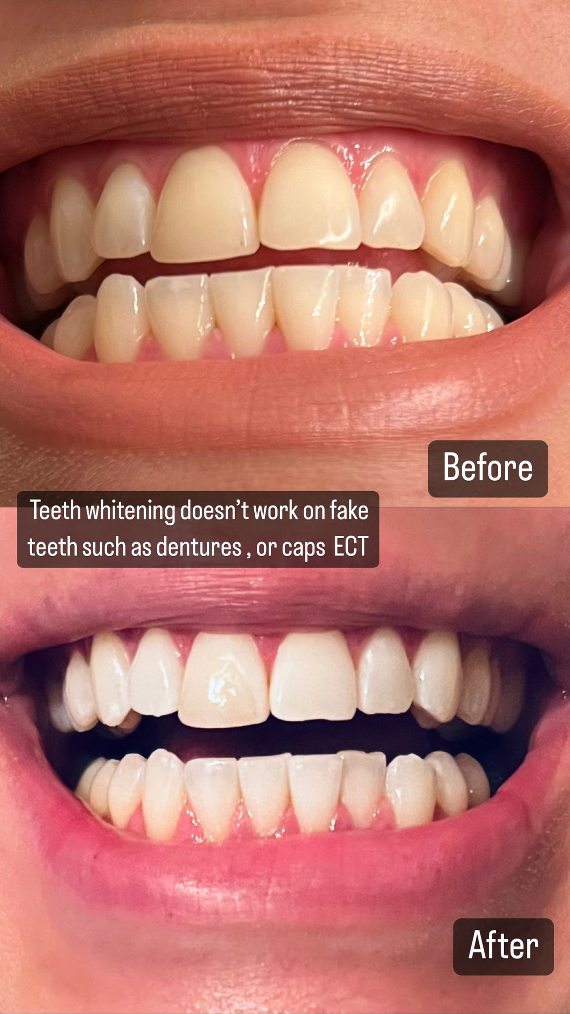 30 minute teeth white session results