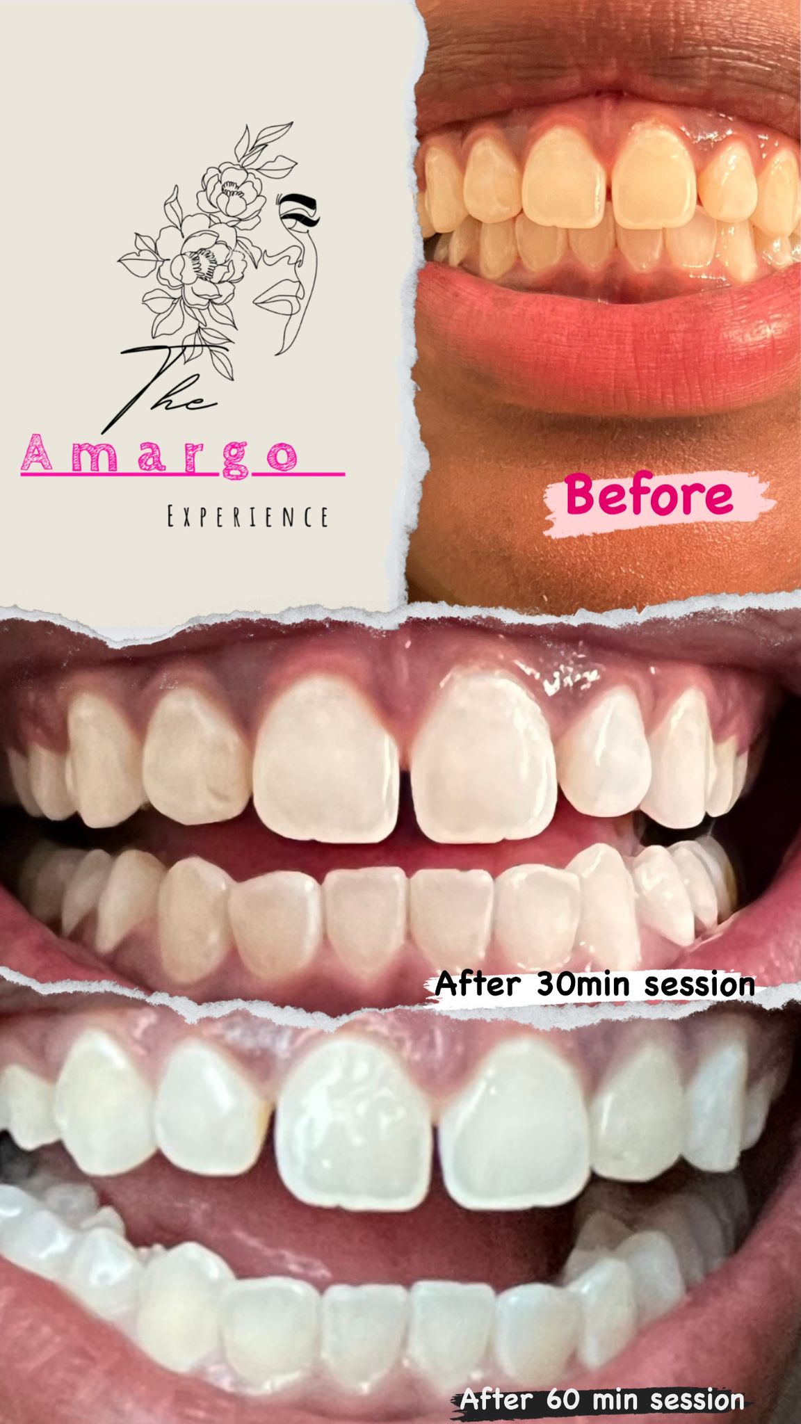 60 minute teeth white session results