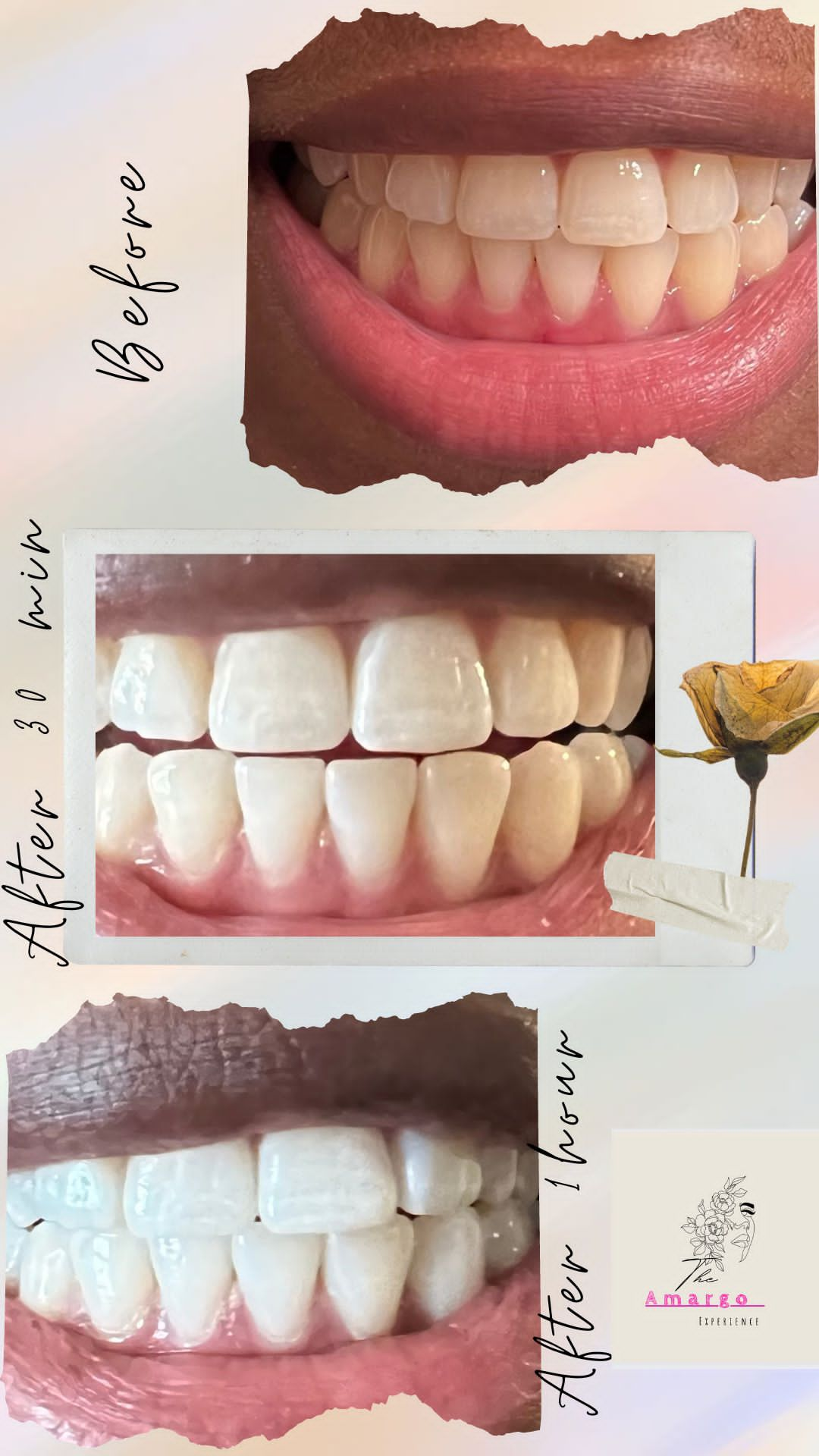 60 minute teeth white session results