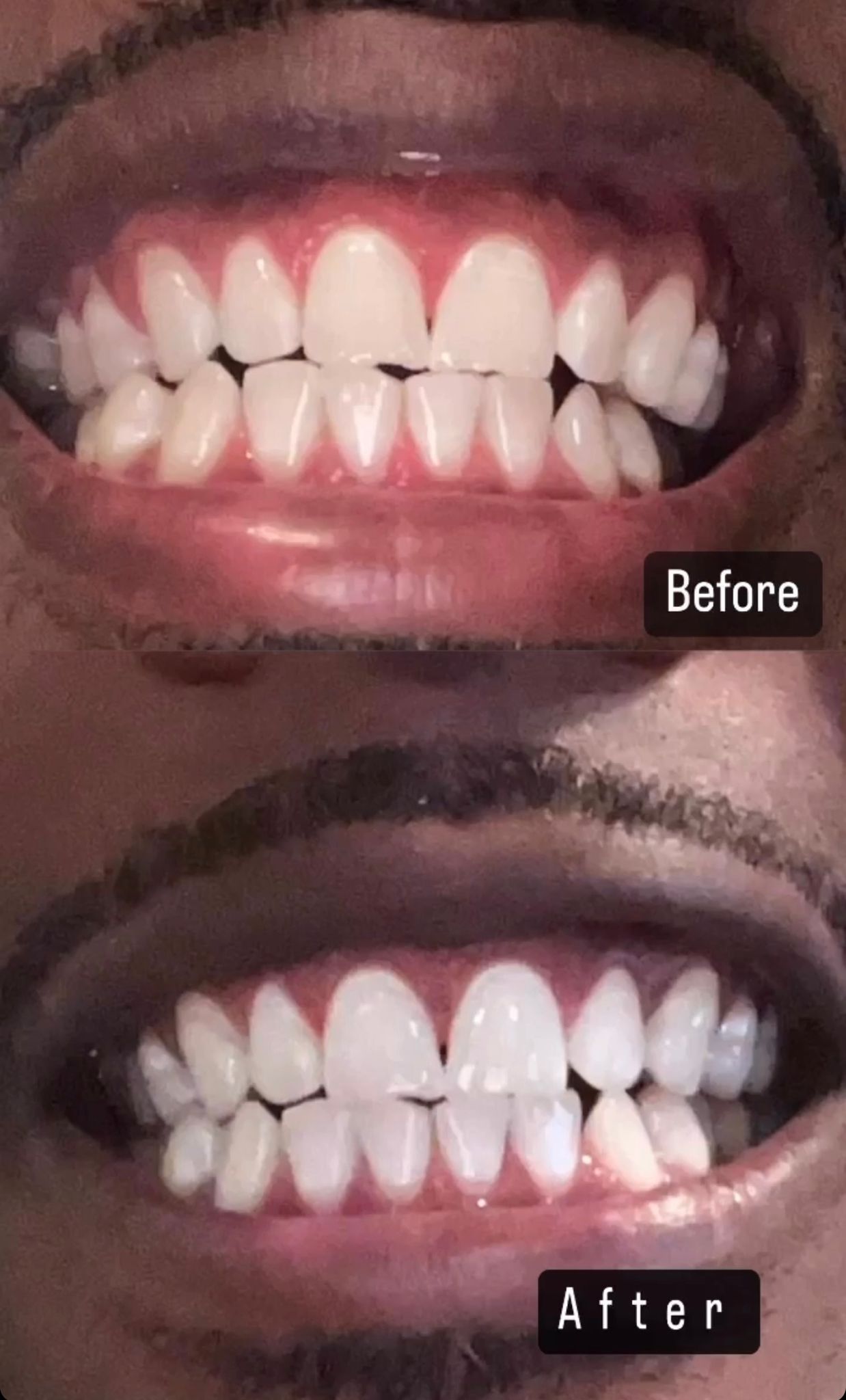 60 minute teeth white session results